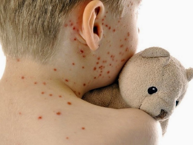 Il morbillo che uccide: oltre 140 mila morti nel 2018, mentre aumentano i casi in tutto il mondo secondo le nuove stime di OMS e CDC