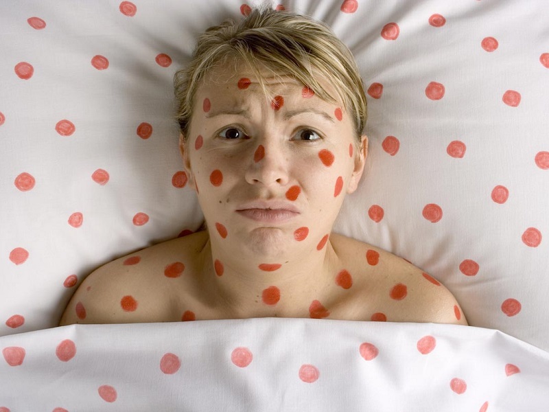 morbillo epidemia in italia 2017