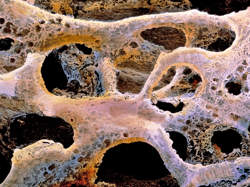 osteoporosi italia dati ecolight