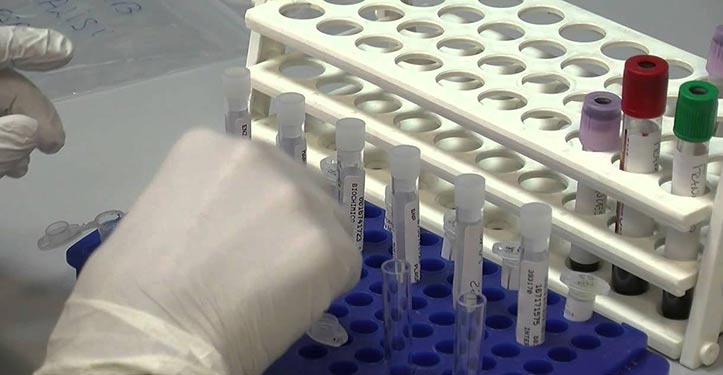 Astrazeneca e Ionis presentano i risultato dello studio di Fase III NEURO-TTRansform nella polineuropatia amiloide ereditaria mediata da transtiretina (ATTRv-PN)