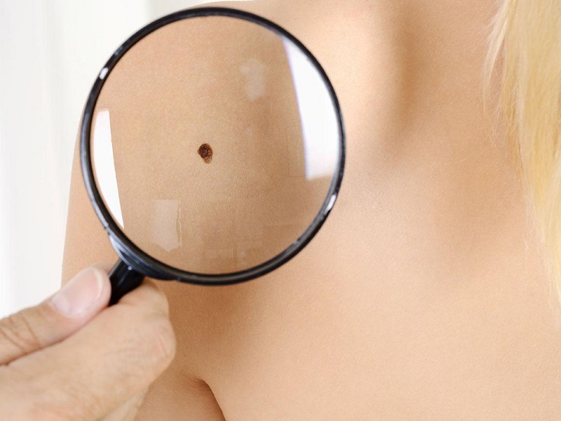 Quasi la metà dei pazienti (48%) con melanoma metastatico, trattati in prima linea con la combinazione di due molecole immunoncologiche è viva a 7 anni e mezzo.