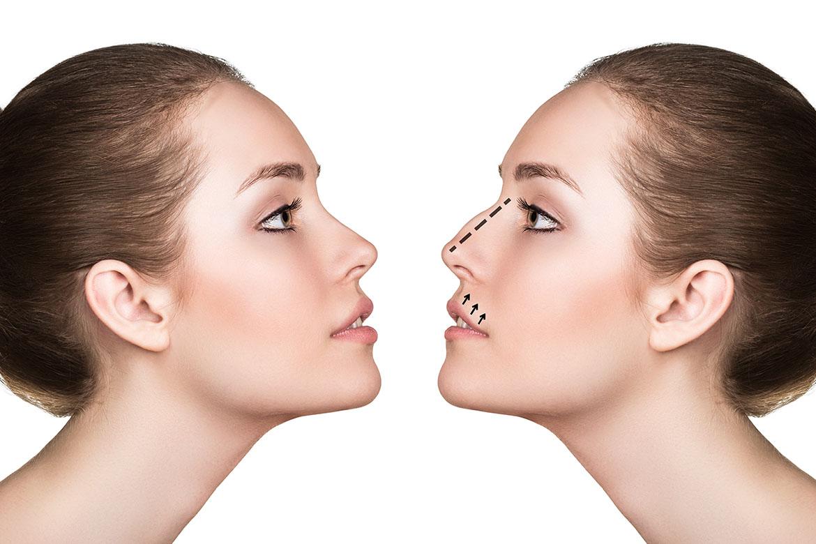 L’inverno è la stagione migliore per chi si sottopone a rinoplastica, intervento al naso