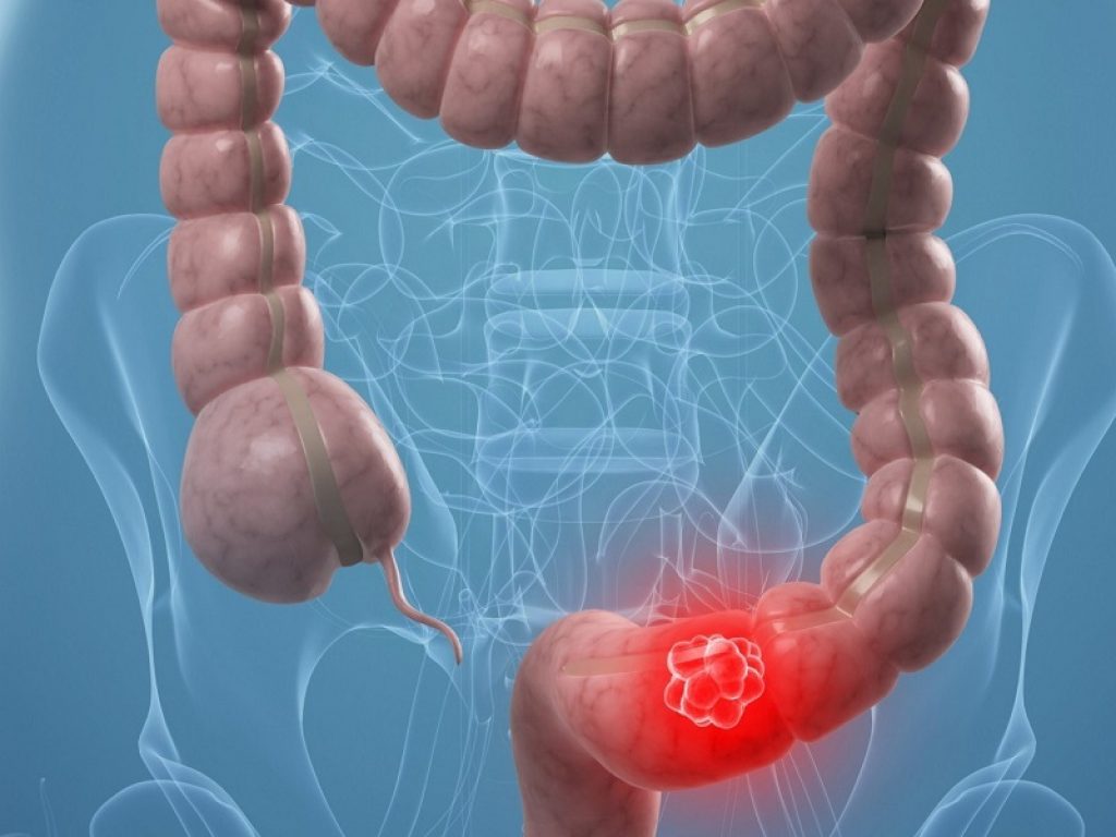 Le diagnosi di tumore del colon sono diminuite di oltre il 40% durante la pandemia: l'importanza degli screening contro la neoplasia