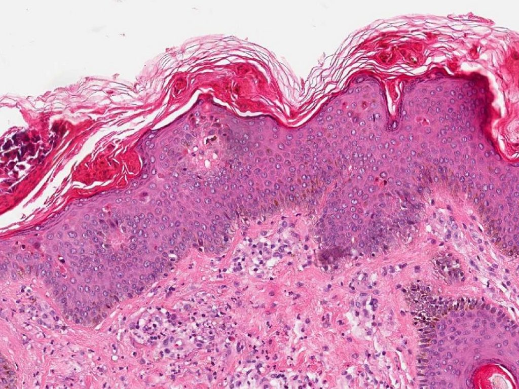 Il Comitato per i Medicinali ad uso Umano (CHMP) dell’Agenzia Europea per i Medicinali (EMA) ha emesso parere positivo per Anakinra nel trattamento della malattia di Still