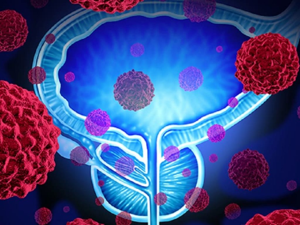 Tumore della prostata: FDA approva darolutamide, nuovo trattamento per i pazienti. L’approvazione si basa sullo studio di Fase III ARAMIS