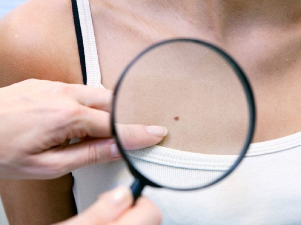 Nei soggetti immunocompromessi, l'esposizione continua alla radiazione ultravioletta è il fattore di rischio modificabile più importante per lo sviluppo di NMSC