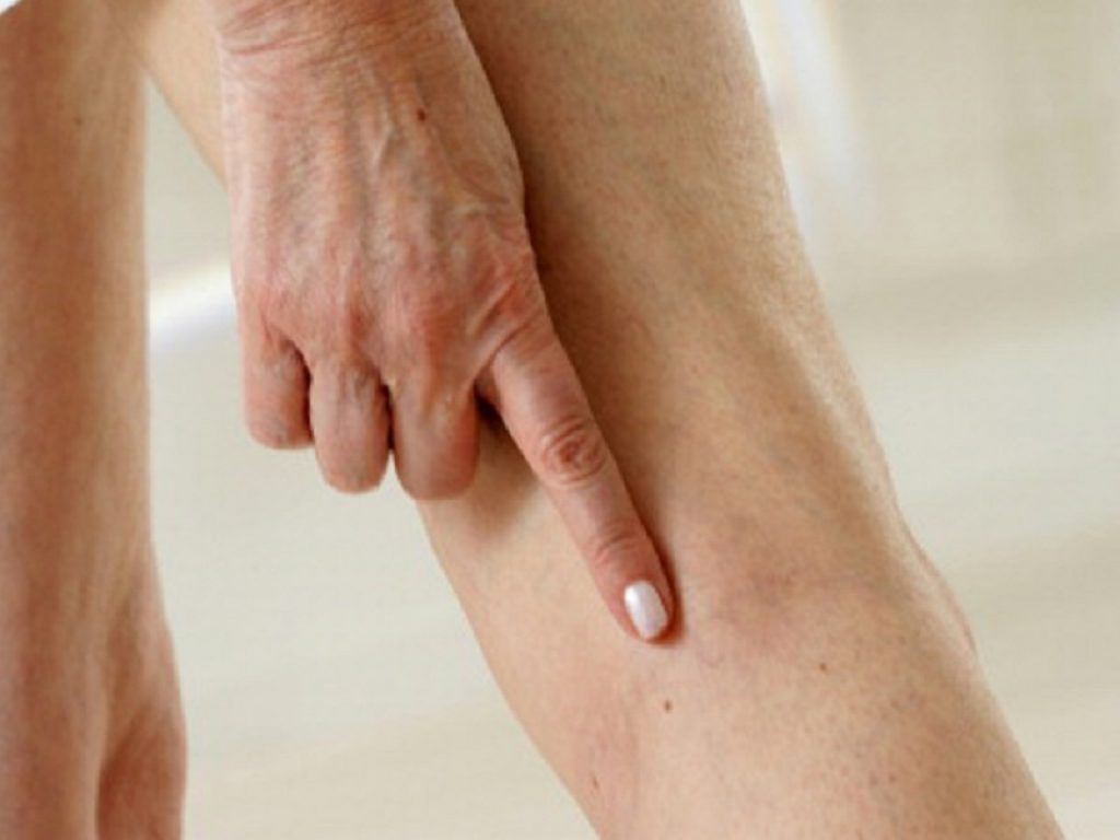 Le vene varicose non sono un problema di salute solo al femminile ma riguardano anche il 25% degli uomini: per trattarle anche l’uso di prodotti d’origine vegetale