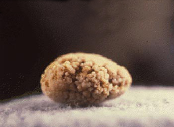 Calcoli ai reni e alle vie urinarie: impatto elevato in Italia, la maggiore incidenza nel Sud Italia. Migliaia di richieste di cure farmacologiche o chirurgiche