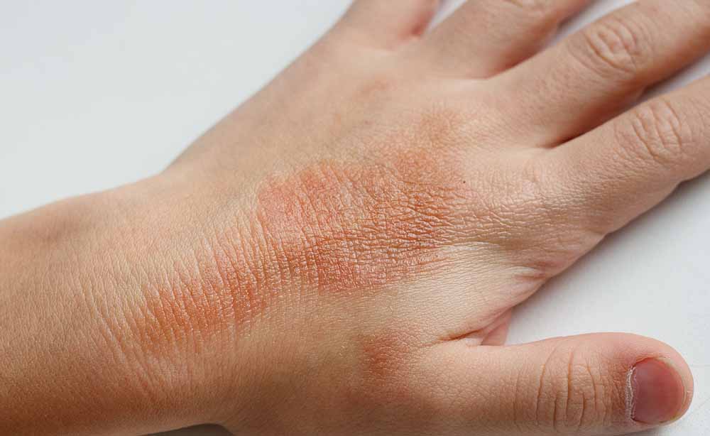 Dermatite atopica: l'anticorpo monoclonale sperimentale anti-OX40 rocatinlimab ha migliorato la lichenificazione, la gravità della malattia e la qualità di vita