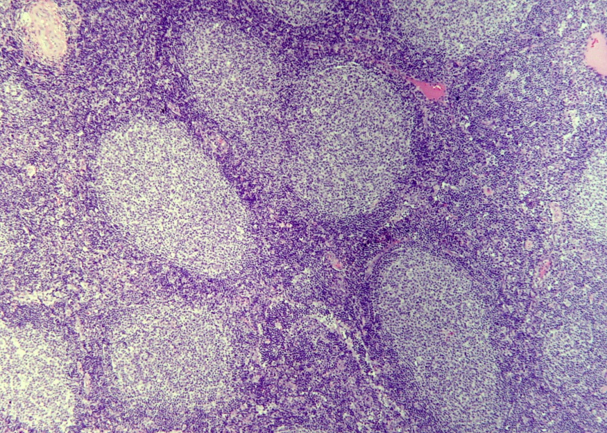 Linfoma follicolare recidivato/refrattario: l'agenzia statunitense Fda approva le CAR-T axi-cel dopo due o più linee di terapia sistemica