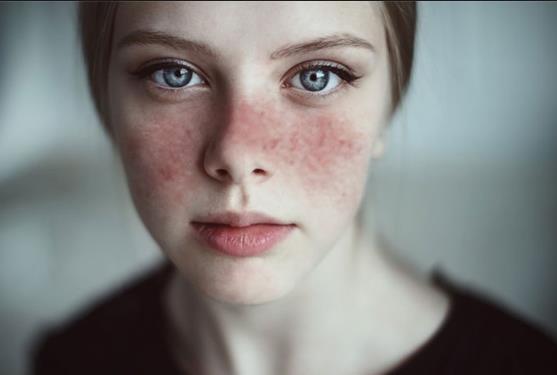 Lupus eritematoso sistemico: con le nuove terapie migliora la qualità della vita. Controllando la malattia, anche la gravidanza è possibile