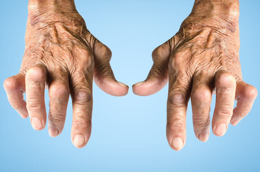 Per baricitinib arrivano conferme di efficacia e sicurezza nel lungo periodo in pazienti con artrite reumatoide secondo i nuovi dati presentati al congresso EULAR 2020