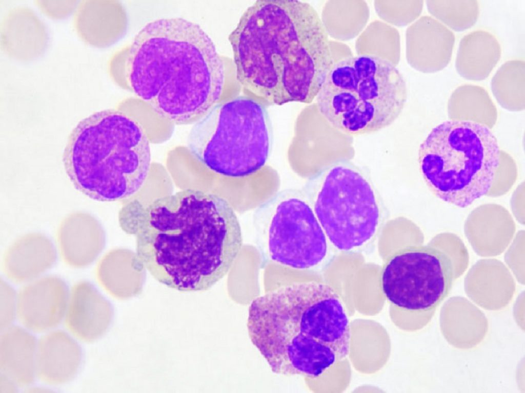 Leucemia linfocitica cronica/linfoma a piccoli linfociti recidivati o refrattari: zanubrutinib è in grado di ritardare la progressione della malattia meglio di ibrutinib