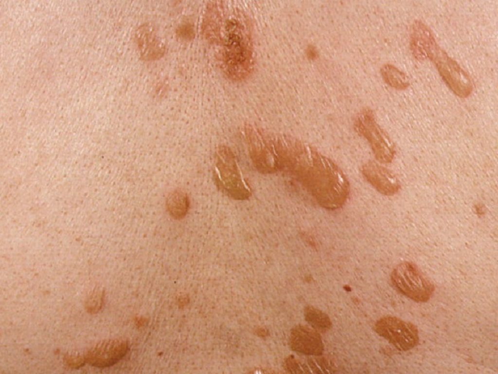 Pemfigo volgare: la Commissione europea ha approvato rituxumab per il trattamento delle forme da moderate a severe