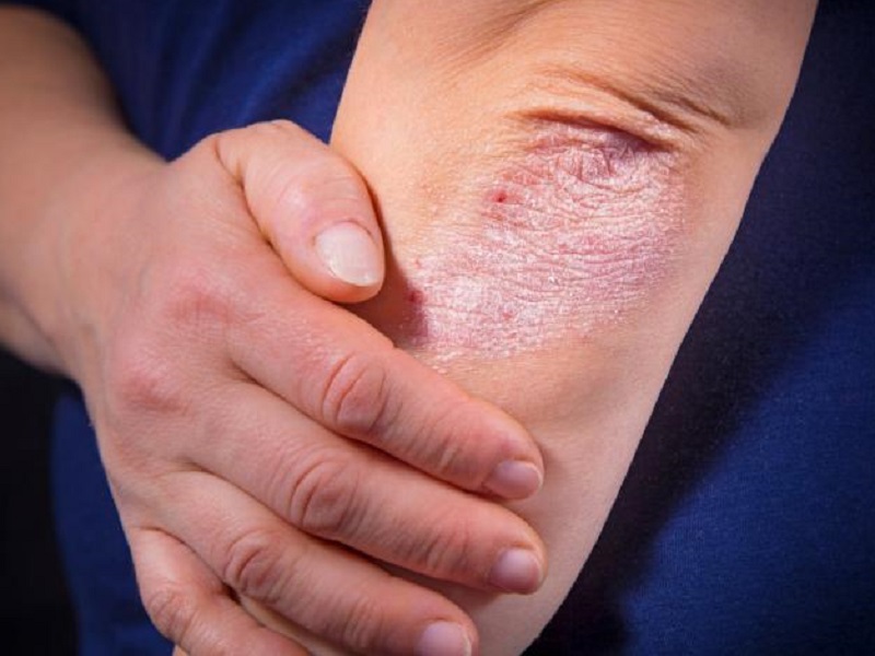 Psoriasi a placche e artrite psoriasica: gli inibitori dell'interleuchina-17 sono generalmente più persistenti degli inibitori del fattore di necrosi tumorale