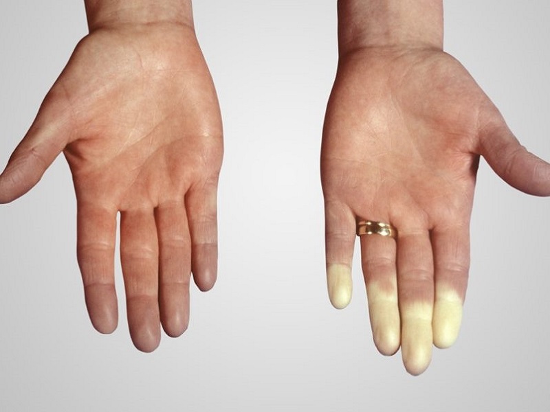 L'osservazione del profilo citochinico è utile per distinguere, tra i pazienti affetti da sclerosi sistemica, quelli a maggior rischio di ipertensione arteriosa polmonare