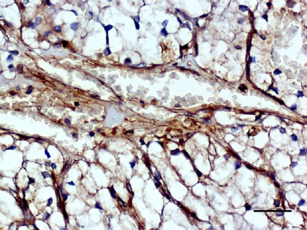 Tumori solidi: l’inattivazione della proteina MICAL2 “disabilita” la risposta delle cellule verso un attore della loro crescita e impedisce la formazione di nuovi vasi sanguigni per “nutrirli”