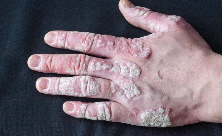 Artrite psoriasica: izokibep