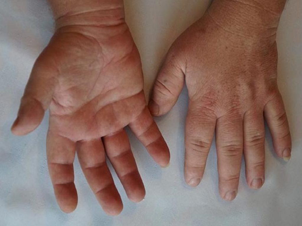 Acromegalia: dal Congresso CUEM buone notizie in ambito terapeutico. Nel corso dell'evento anche un focus sulle comorbilità associate alla malattia