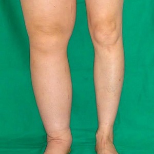 Il linfedema, gonfiore al braccio o alla gamba che diventa dolente a causa di un’ostruzione linfatica, è una patologia che può avere diverse cause e va trattata con i tempi giusti