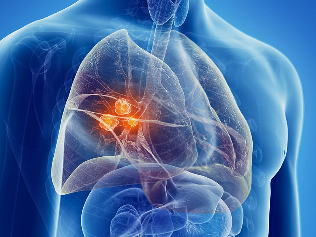 Tumore del polmone non a piccole cellule: ok dell’Agenzia Europea del Farmaco per osimertinib come terapia adiuvante per i pazienti positivi alla mutazione di EGFR