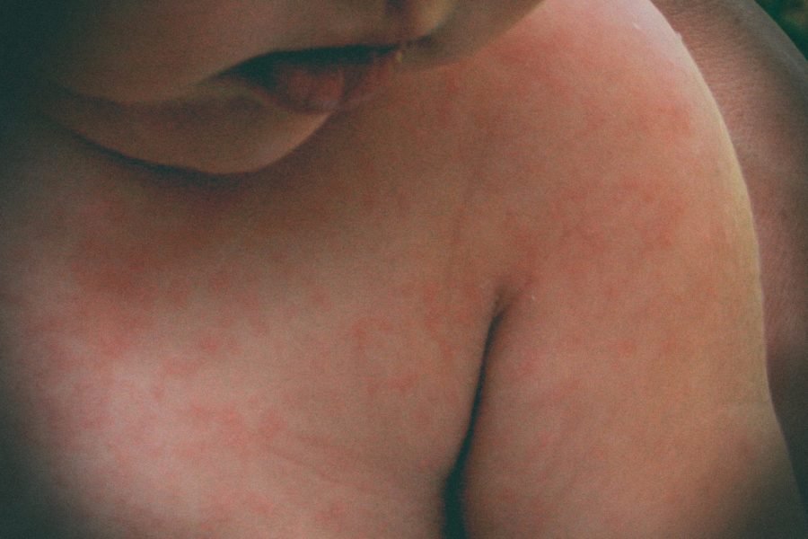 Il morbillo ora è un'emergenza mondiale: casi triplicati nel 2019, l'Organizzazione Mondiale della Sanità in allerta per i continui focolai