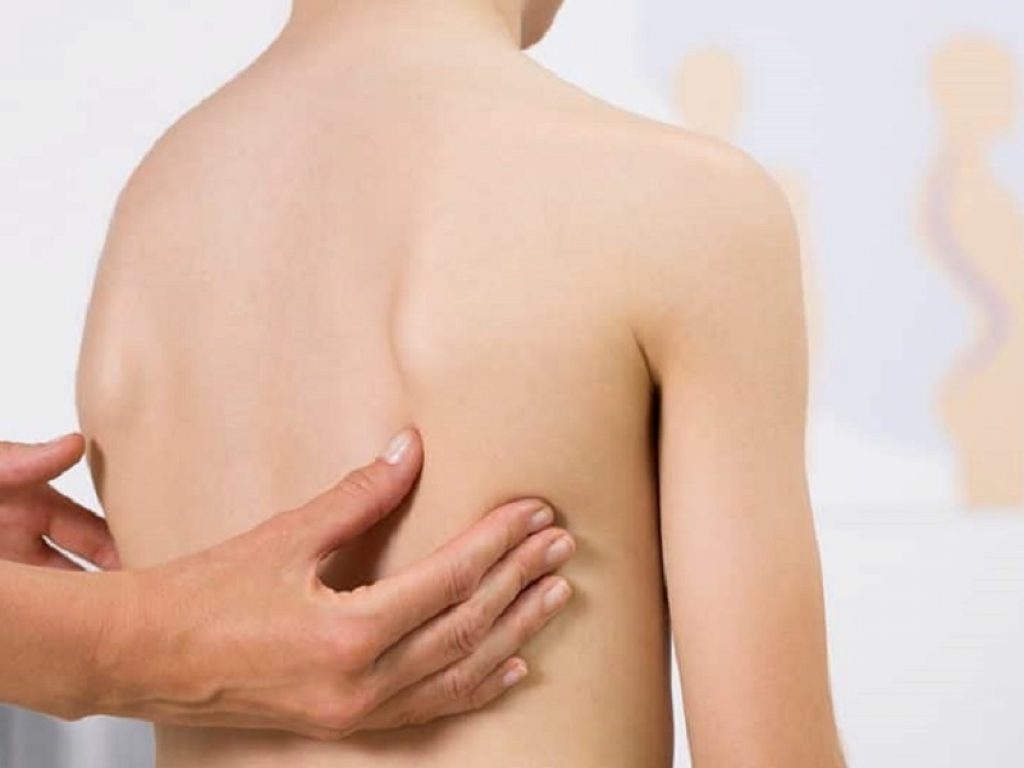 Scoliosi: al Bambino Gesù si corregge con la chirurgia "flessibile" che consente una maggiore mobilità dopo l'intervento. Sono 6 i giovani pazienti sottoposti alla procedura innovativa