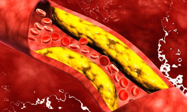 Malattia cardiovascolare aterosclerotica (ASCVD): il trattamento con inclisiran, due iniezioni all'anno, dimezza il colesterolo LDL