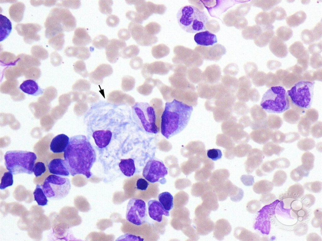 Malattia di Gaucher: il rischio di mieloma multiplo è 2-4 volte più alto. La terapia enzimatica sostitutiva può migliorare la citopenia e facilitare la somministrazione dei farmaci anti-mieloma