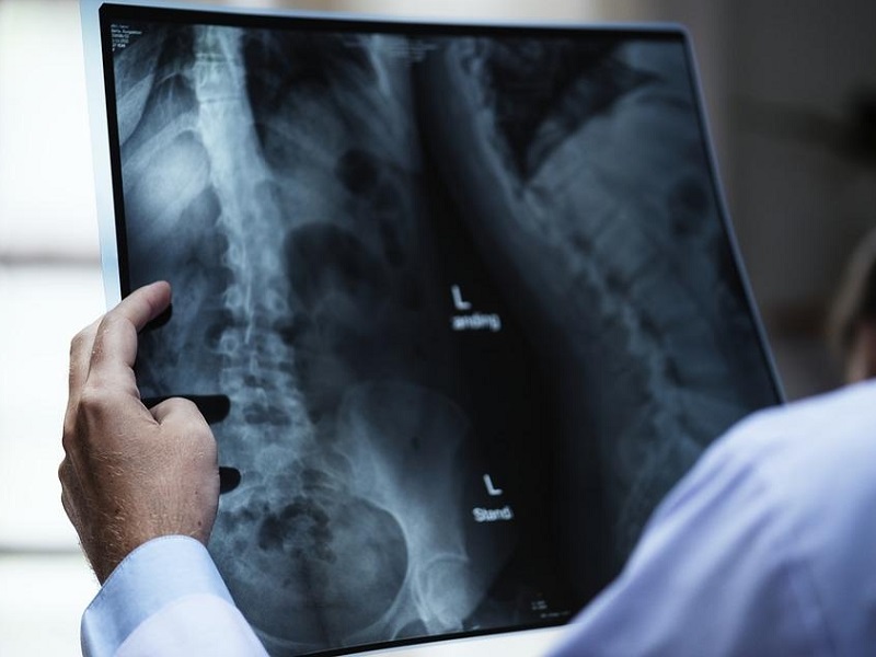 Osteoporosi: romosozumab si dimostra essere efficace e sicuro indipendentemente dal grado di compromissione della funzione renale