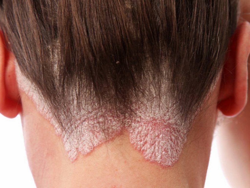 Psoriasi a placche da moderata a grave, l'Agenzia italiana del farmaco ha autorizzato la rimborsabilità di certolizumab pegol.