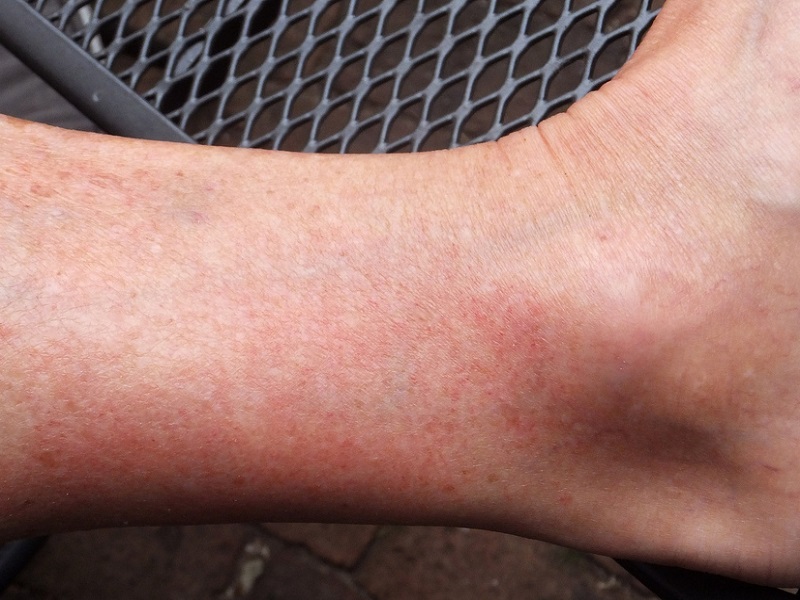 Vasculiti ANCA-associate: avacopan agisce efficacemente sulle recidive secondo nuovi dati da analisi post-hoc studio ADVOCATE