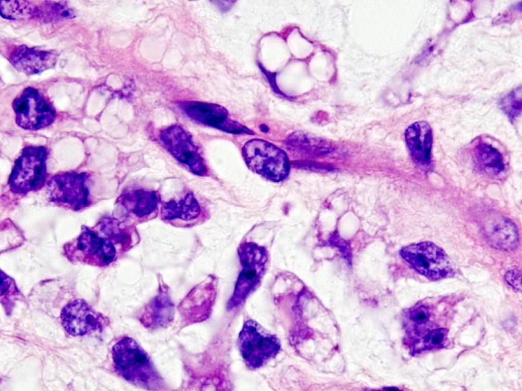 Sarcoma: cabozantinib ha dimostrato un'attività antitumorale interessante come trattamento per pazienti con sarcoma di Ewing e osteosarcoma