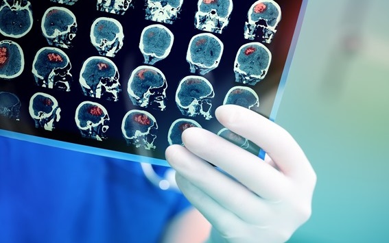 Il colesterolo prodotto nel cervello sembra svolgere un ruolo chiave nello sviluppo della malattia di Alzheimer secondo un nuovo studio