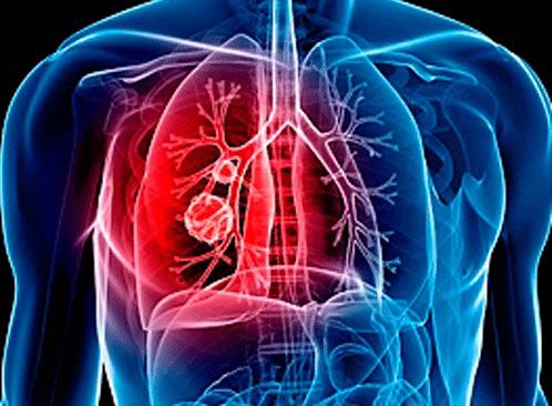 La Commissione europea ha approvato la doppia combinazione nivolumab/ipilumab con due cicli di chemioterapia per il trattamento del tumore al polmone