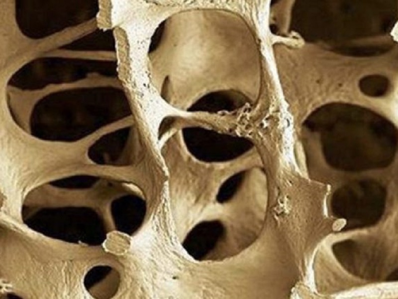 Osteoporosi post-menopausale: teriparatide migliora gli indici di qualità ossea a livelli pre-menopausa secondo un nuovo studio