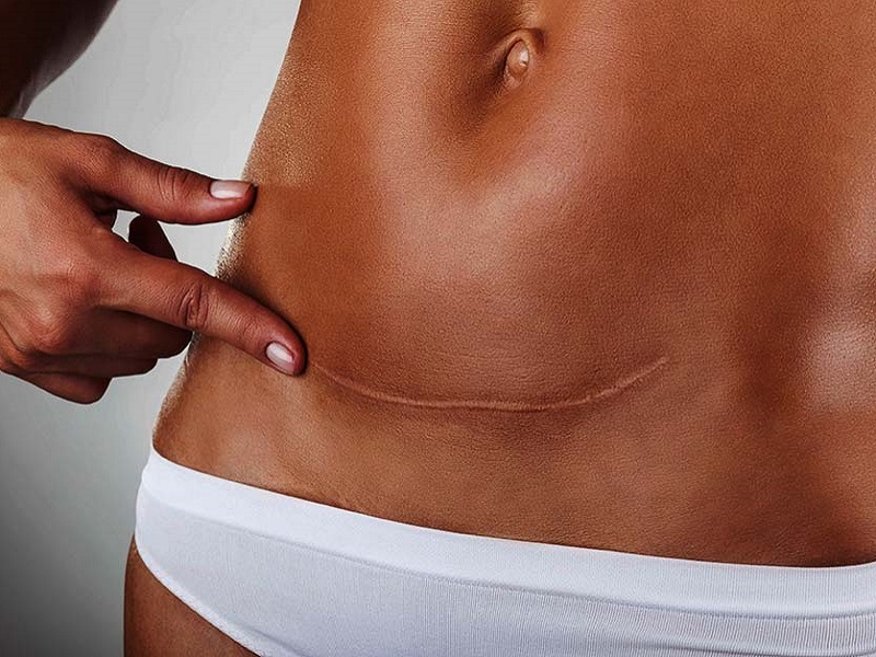 Le donne nate con parto cesareo corrono un rischio maggiore di sviluppare obesità e diabete di tipo 2 da adulte rispetto a quelle nate con parto vaginale