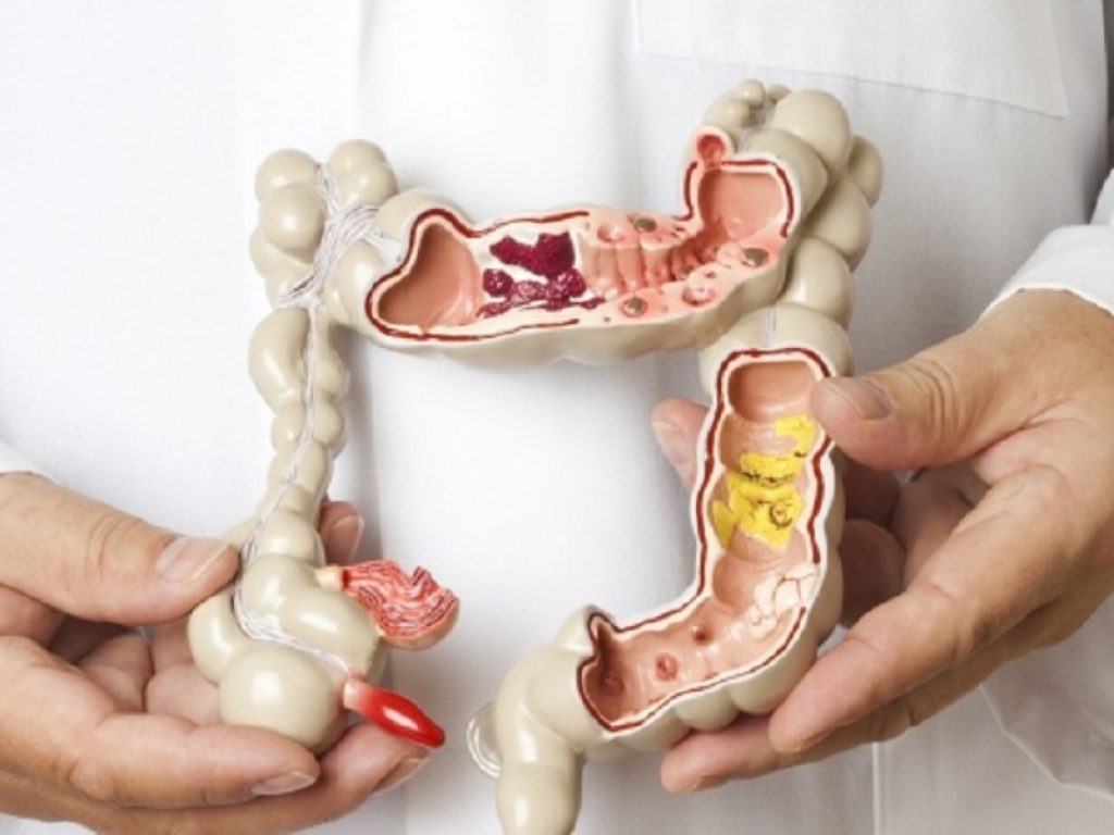 Colite ulcerosa: upadacitinib (15 mg o 30 mg, una volta al giorno) ha raggiunto l'endpoint primario della remissione clinica 