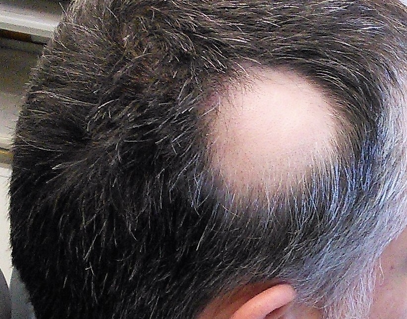 Nei pazienti affetti da alopecia areata, il trattamento con ritlecitinib ha consentito un miglioramento continuo della gravità della malattia e della ricrescita dei capelli