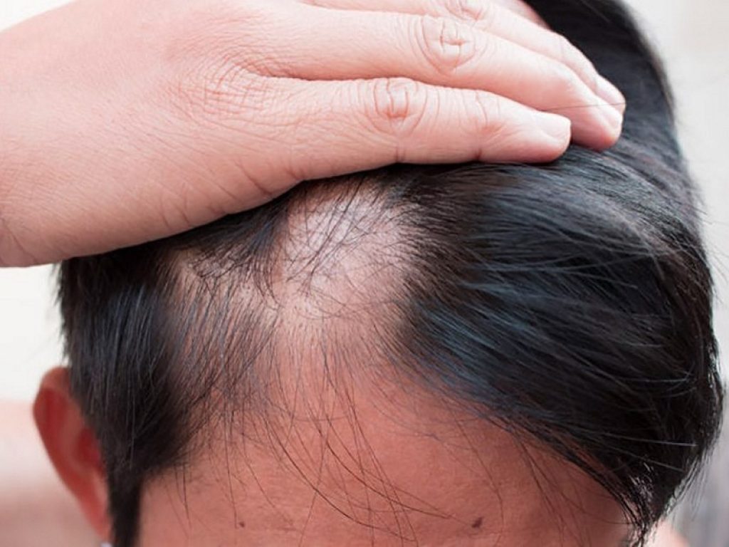 Caduta dei capelli: è compito dello specialista comprenderne la causa e indicare al paziente il percorso terapeutico adeguato