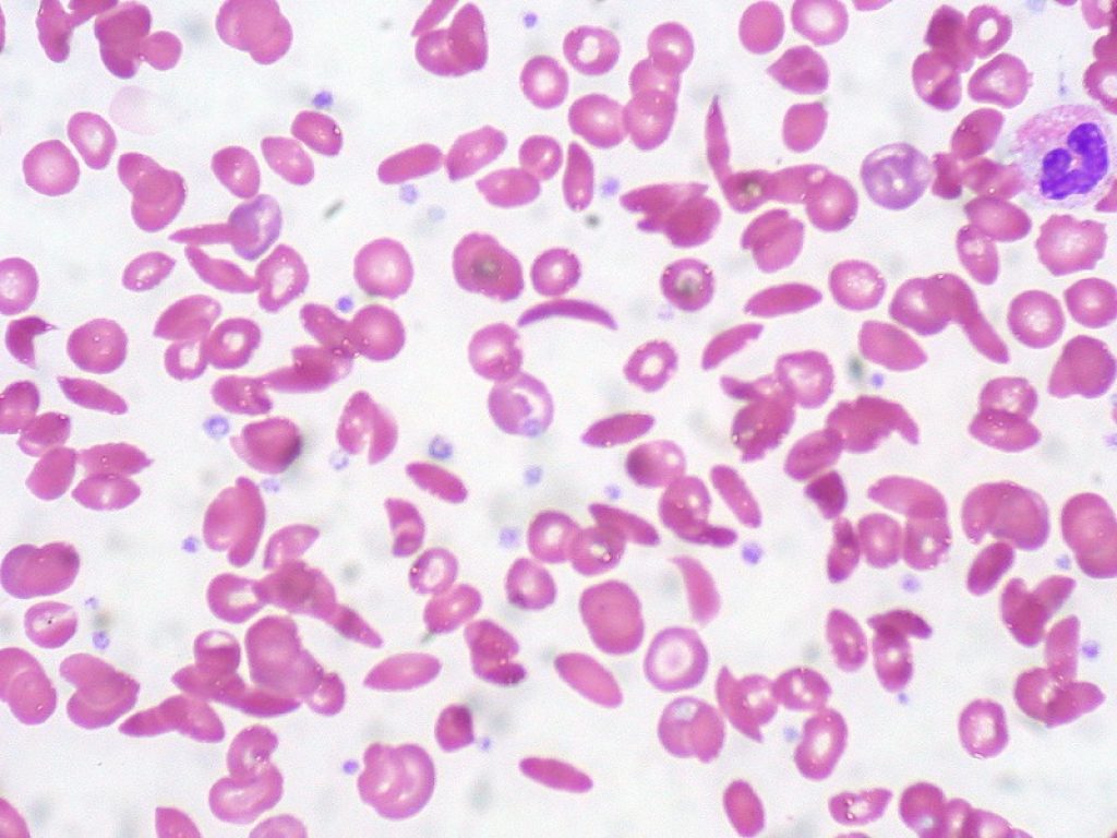 Anemia falciforme: si fermano due studi clinici di fase I/II e di Fase III con la terapia genica per sospetti casi di cancro 
