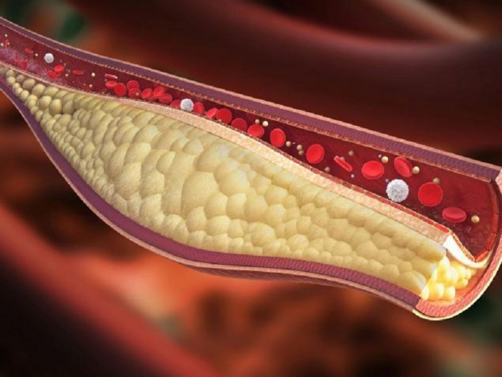 Sindrome da chilomicronemia multifattoriale: volanesorsen riduce significativamente i livelli di trigliceridi e gli eventi di pancreatite acuta