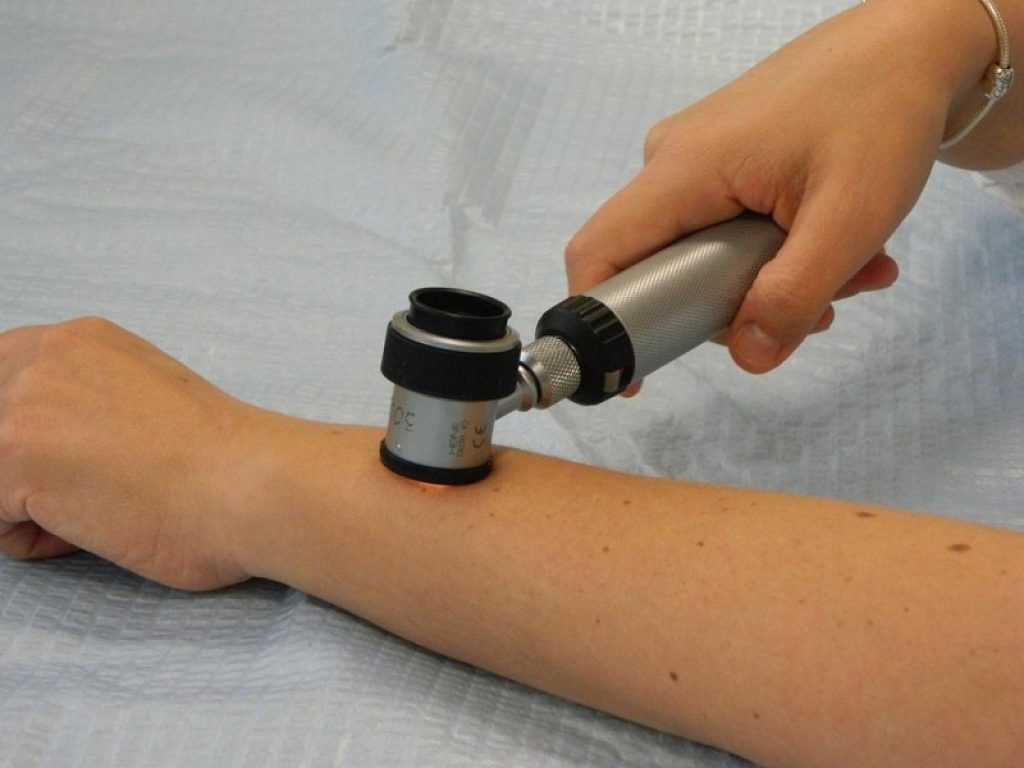 Vitiligine ecco come si cura