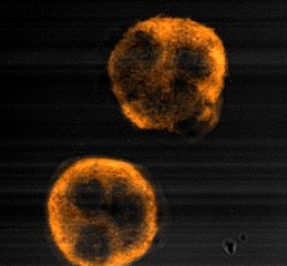 La Granulomatosi di Wegener è una vasculite: per la malattia rara le terapie con farmaci immunosoppressivi sono efficaci