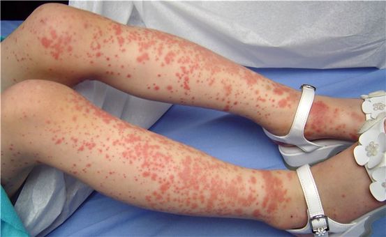 Porpora di Schoenlein Henoch: nel 25-40% dei casi si può avere un coinvolgimento renale. Se il coinvolgimento è grave serve una biopsia renale