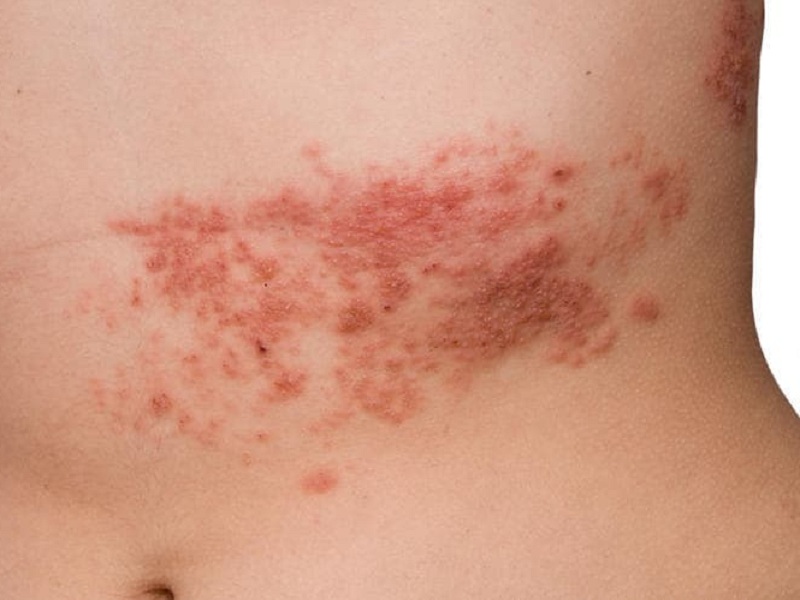 Un modello 3D per studiare la relazione tra Alzheimer e Herpes: modello tridimensionale di cellule staminali neurali messo a punto da ricercatori USA