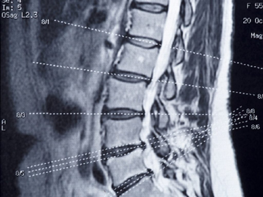 Frattura osteoporotica: troppi pazienti non ricevono adeguati trattamenti farmacologici di follow-up secondo un nuovo studio austriaco