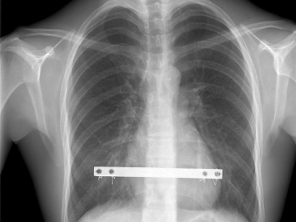 Pectus excavatum: se accompagnato da disturbi del ritmo cardiaco o difficoltà respiratorie durante lo sforzo, l’intervento chirurgico diventa necessario