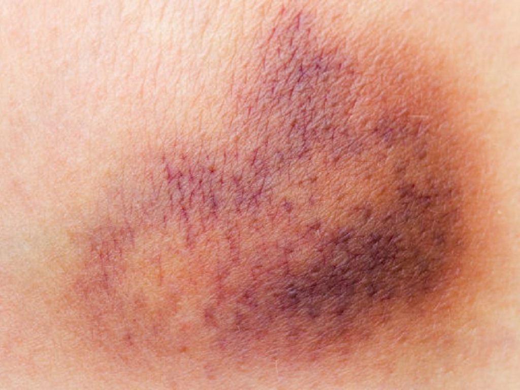 Porpora di Schoenlein Henoch: nel 25-40% dei casi si può avere un coinvolgimento renale. Se il coinvolgimento è grave serve una biopsia renale