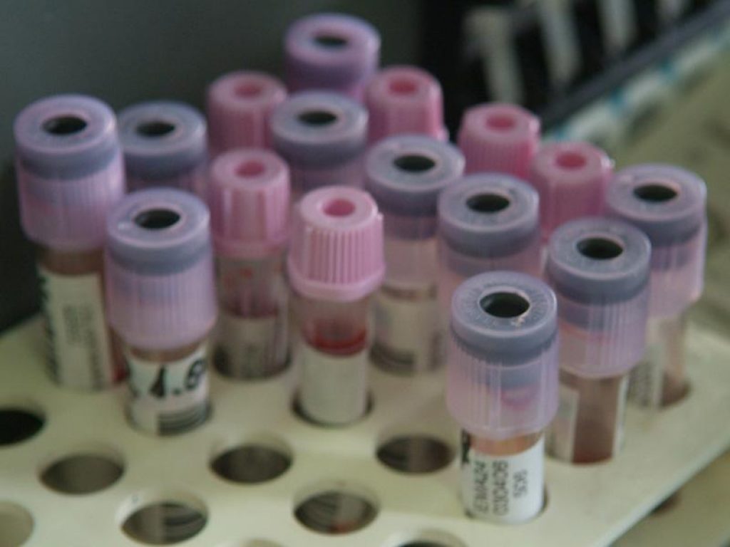 Tiroidite di Hashimoto: l’esordio della patologia è lento e asintomatico. Attenzione agli esami da fare, gli esperti spiegano quali sono quelli giusti